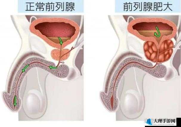 尿道口肥大的常见原因究竟是什么呢